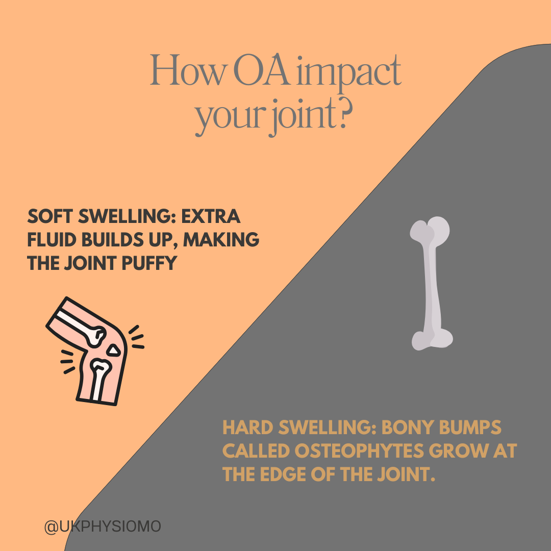 Osteoarthritis can lead to hard and soft swelling.